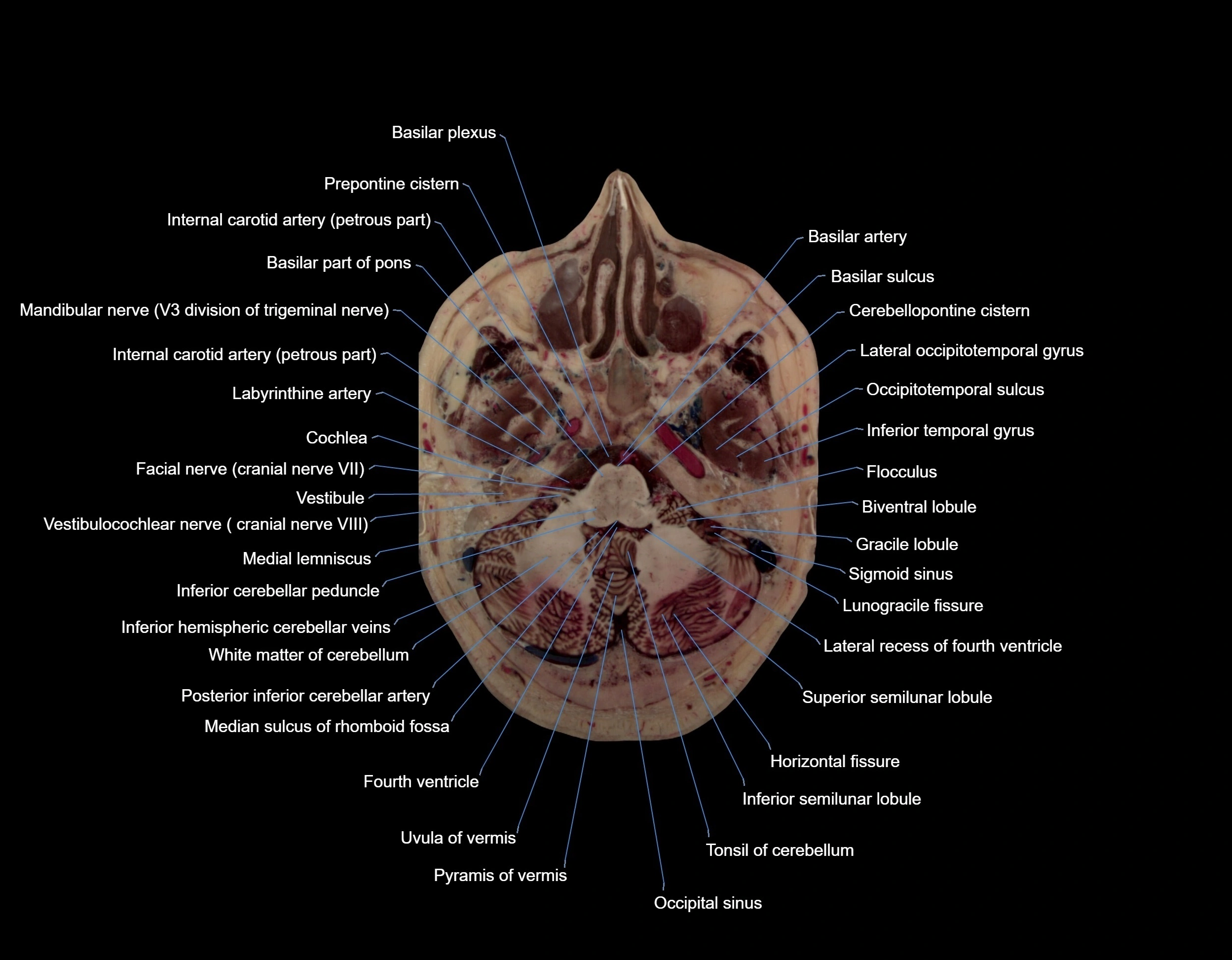 MRI Brain axial cross sectional radiology anatomy 3T image  -img-000016.webp
